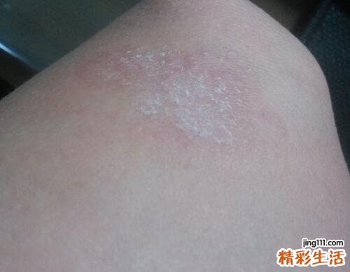 您需要警惕的银屑病并发症