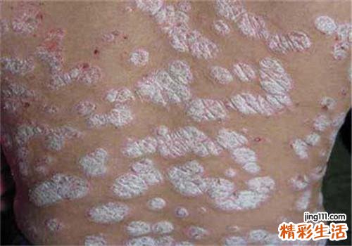 银屑病会传染给别人吗