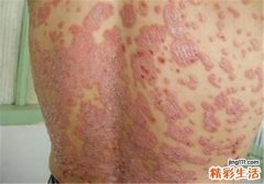 银屑病会遗传给下一代吗