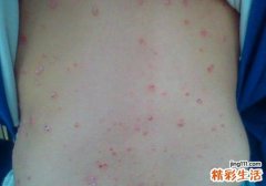 银屑病分为哪几种类型