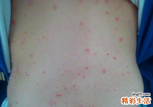 银屑病分为哪几种类型