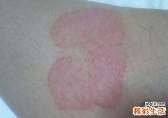 银屑病复发的原因有哪些