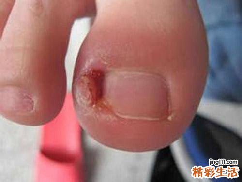 甲沟炎有脓怎么排脓