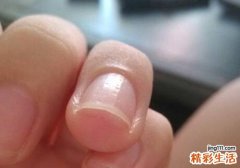 指甲长到肉里怎么办