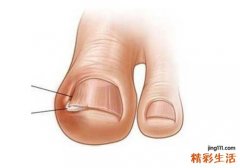 什么是甲沟炎 甲沟炎的常规处理方法