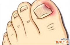 脚趾甲长到肉里怎么办 三招教你轻松搞定