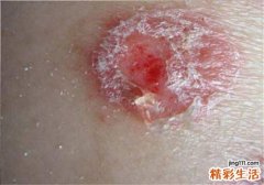 牛皮癣症状