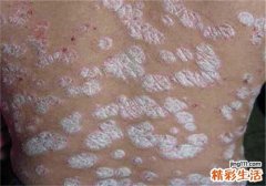 牛皮癣传染吗