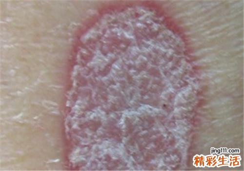 牛皮癣怎么治