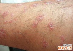牛皮癣会传染吗 为什么牛皮癣不会传染