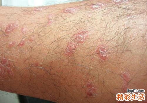 牛皮癣会传染吗 为什么牛皮癣不会传染