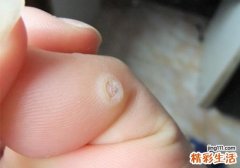 鸡眼是怎么形成的