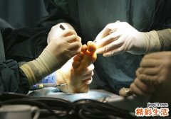鸡眼怎么根治