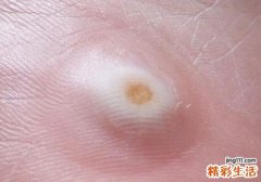 鸡眼是怎么形成的注意哪些饮食