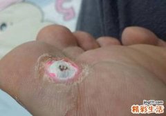 鸡眼贴到什么程度才算好