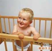 水痘的症状和预防