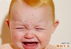 水痘的症状和治疗