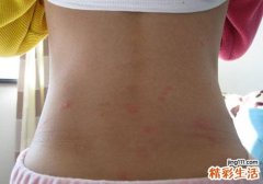 宝宝长水痘可以洗澡吗