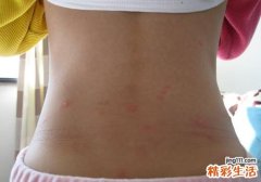 水痘潜伏期会传染吗