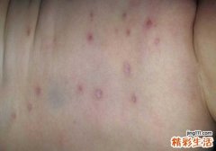 水痘需要隔离多长时间