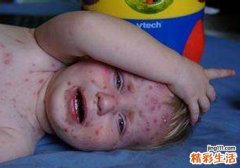 水痘破了能擦炉甘石吗