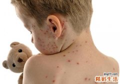 如何预防水痘 水痘护理四要点