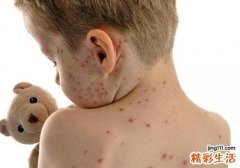 水痘是怎么引起的 出水痘不能吃什么