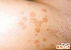 肛门湿疹和癣的区别 五种区别教你分辨湿疹和癣