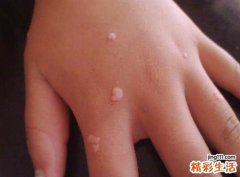 扁平疣怎么去除