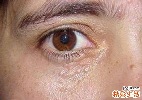 眼部扁平疣有什么危害