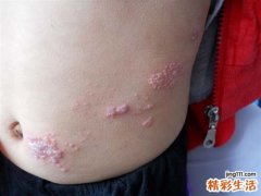 带状疱疹传染吗