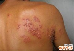 带状疱疹症状有哪些