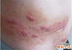 带状疱疹怎么治疗