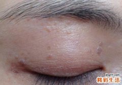 眼部扁平疣会传染吗