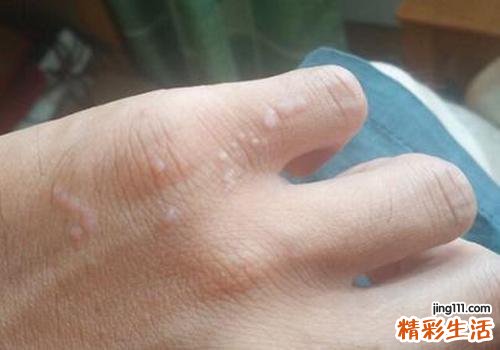 扁平疣冷冻后起水泡怎么办