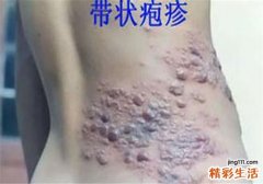 带状疱疹可以根治吗