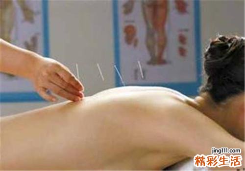 带状疱疹可以针灸吗