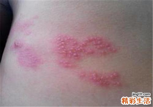 带状疱疹好了还会复发吗