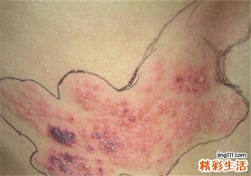 带状疱疹传染途径