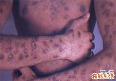 带状疱疹和艾滋病有关系吗