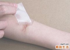 疤痕痒是什么原因 疤痕痒注意事项