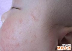 新生儿痤疮怎么治疗 娂褺aby也有长青春痘吗？