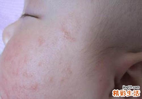 新生儿痤疮怎么治疗 娂褺aby也有长青春痘吗？