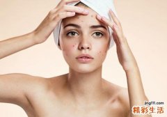 痤疮是由什么引起的 痤疮该怎么治疗