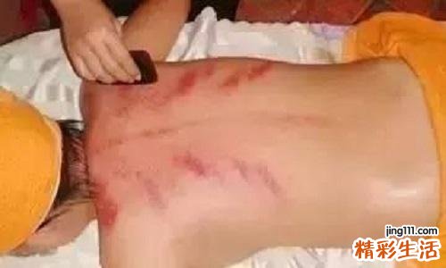 长痤疮刮痧什么部位 痤疮刮痧方法