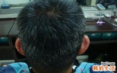 长白发吃什么调理 预防白发的5种方法