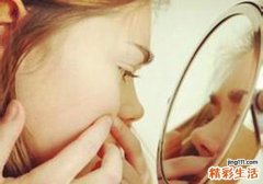 闭合粉刺一定要挤出来吗