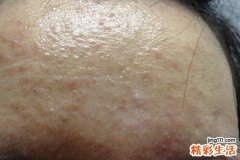 额头上起闭口什么原因 闭口粉刺怎么形成的