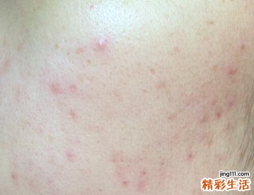 闭口粉刺会自己消失吗