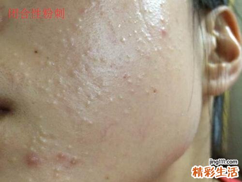 脂肪粒和闭合性粉刺的区别 闭口粉刺和脂肪粒的区别